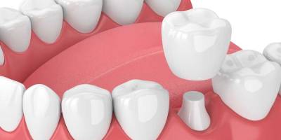 Cover Broken Teeth With Dental Crowns