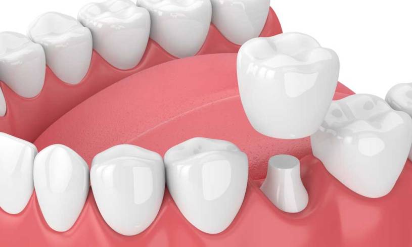 Cover Broken Teeth With Dental Crowns